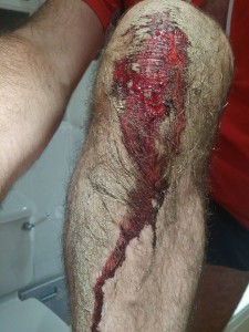 Bloody knee after a fall whilst Hashing