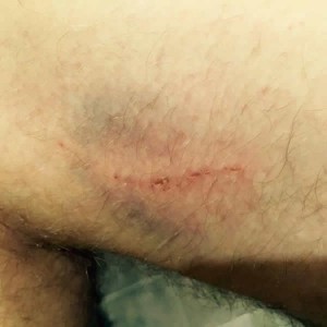 Bruise and scratches incurred whilst Hashing