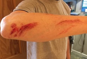 SH4 Hasing Injury -Dim Wit's grazed arm